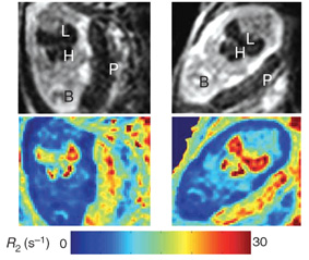 Overexpressed ferritin shows up in MRI 